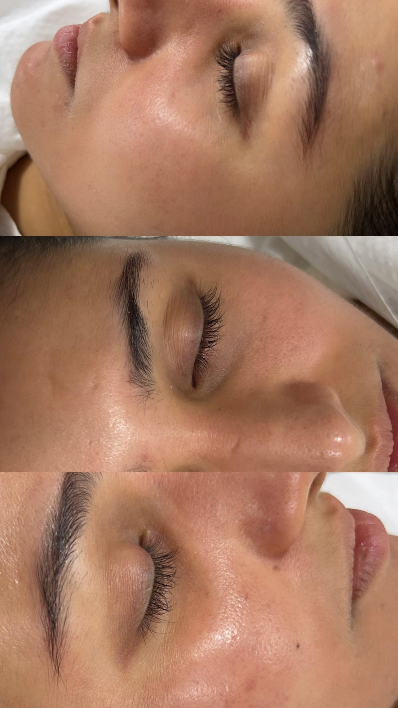 Smile Transformation