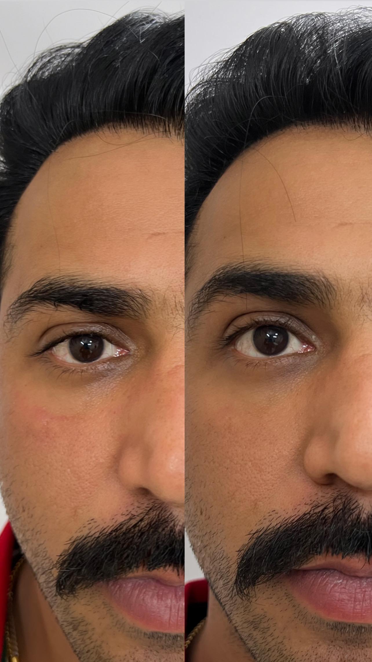 Smile Transformation