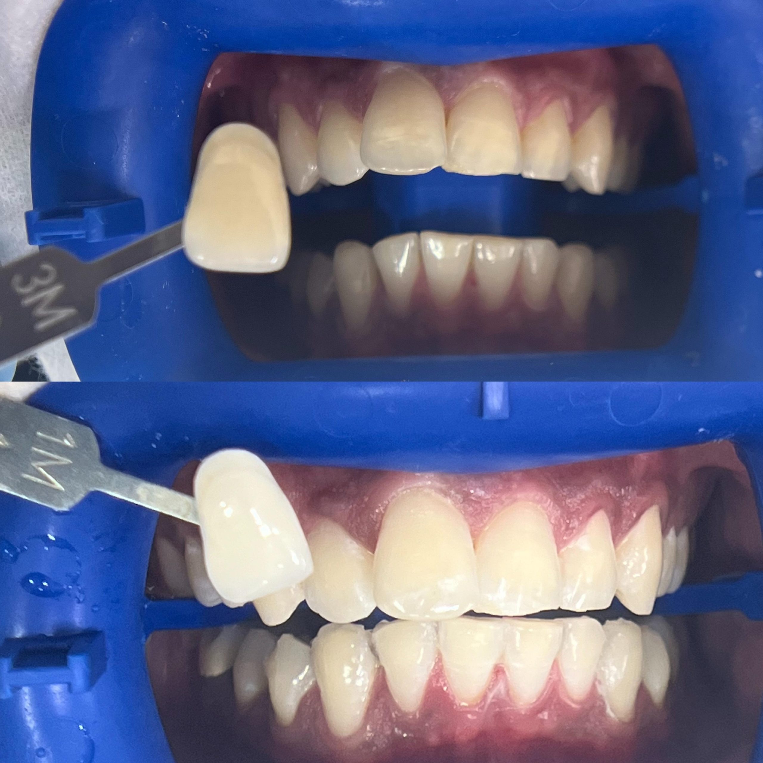 Smile Transformation