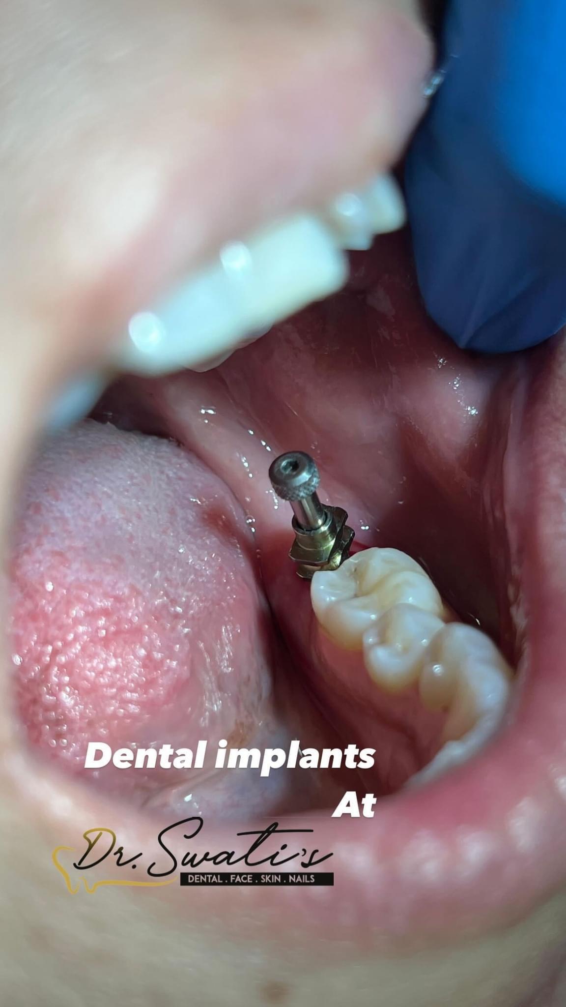 Dental Implants