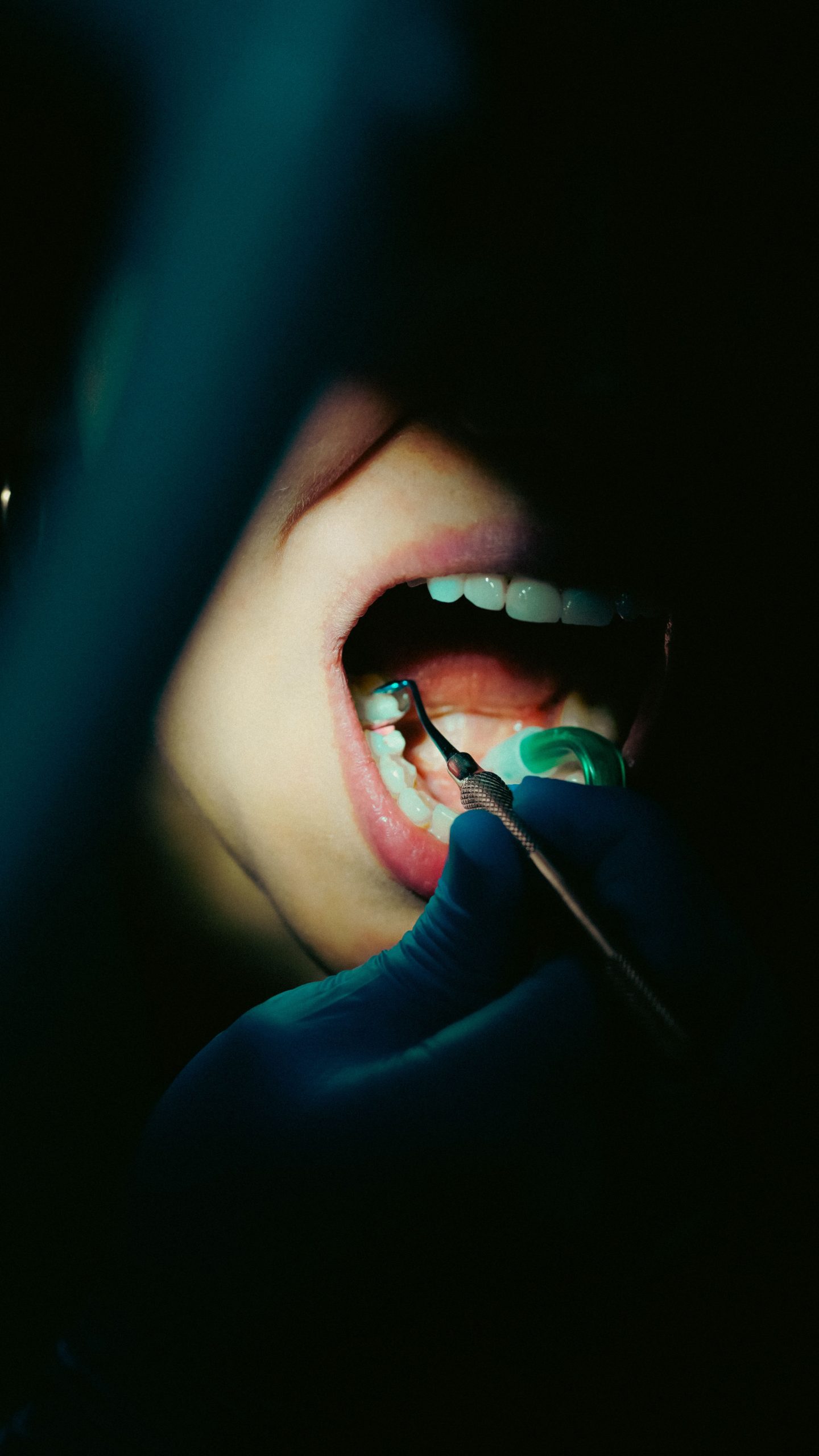 Root Canal Treatment