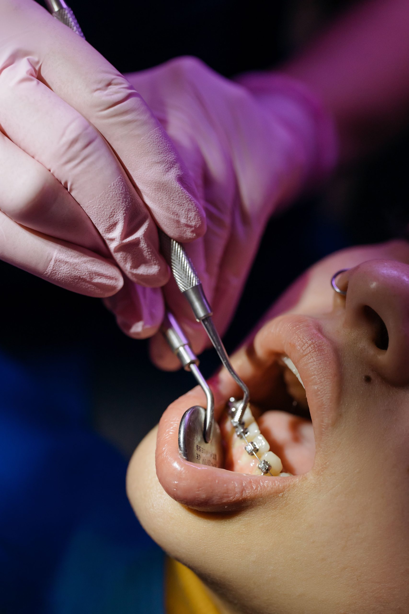 Braces & Aligners
